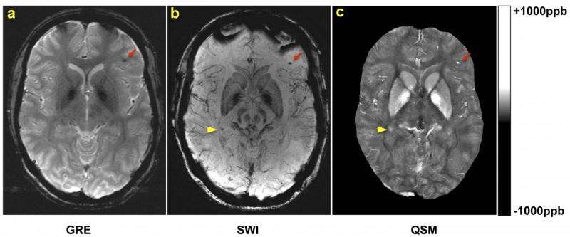 La Risonanza magnetica (MRI) migliora la diagnosi nell´individuazione delle microemorragie dopo un trauma cranico