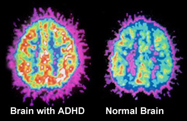 ADHD Sindrome da deficit di attenzione e iperattività